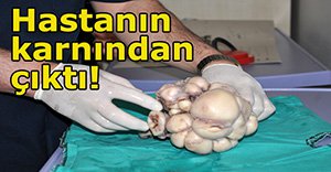 Karnından dev kütle çıktı!