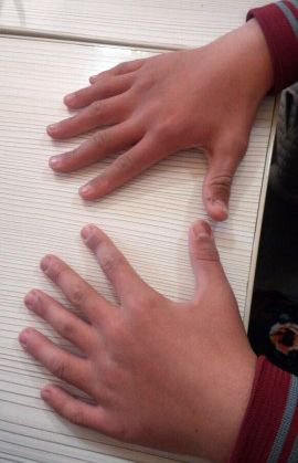 UMUT EREN 6 PARMAKLI YAŞIYOR