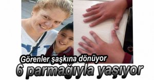 UMUT EREN 6 PARMAKLI YAŞIYOR