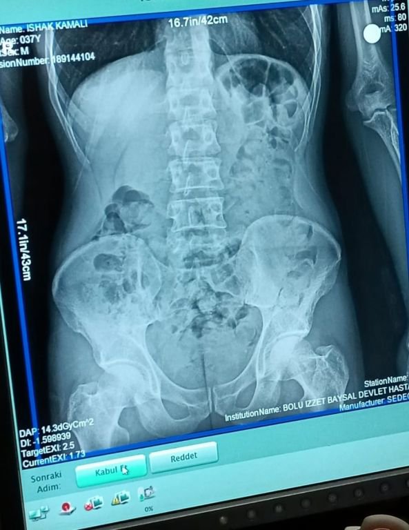 UYUŞTURUCUYU SAKLADIĞI YER ŞOKE ETTİ