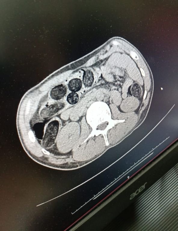 UYUŞTURUCUYU SAKLADIĞI YER ŞOKE ETTİ